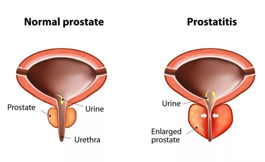Normál prosztata és gyulladt